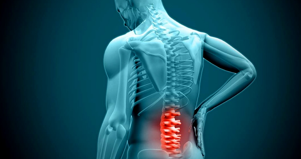 Hernia discal